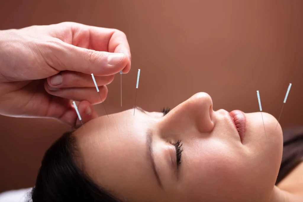 acupuncture treatment in North York